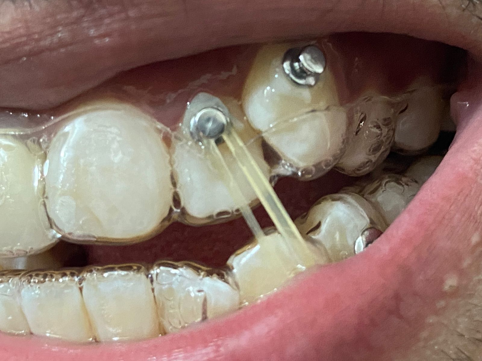 Invisible Aligners